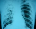Ситуація із захворюванням на туберкульоз загрозлива