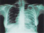 Щороку від туберкульозу у світі гине два мільйони людей, в Україні – 11 тисяч