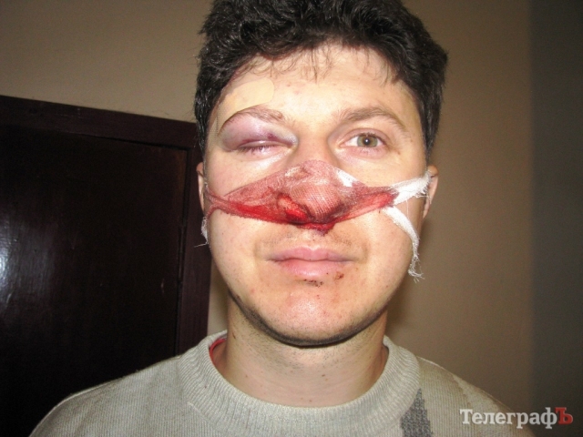Громадського активіста Михайла Берчука побили у селищі Власівка
