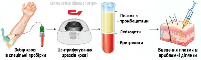 Плазмоліфтинг — ефективне та безпечне омолодження Плазмоліфтинг — ефективне та безпечне омолодження